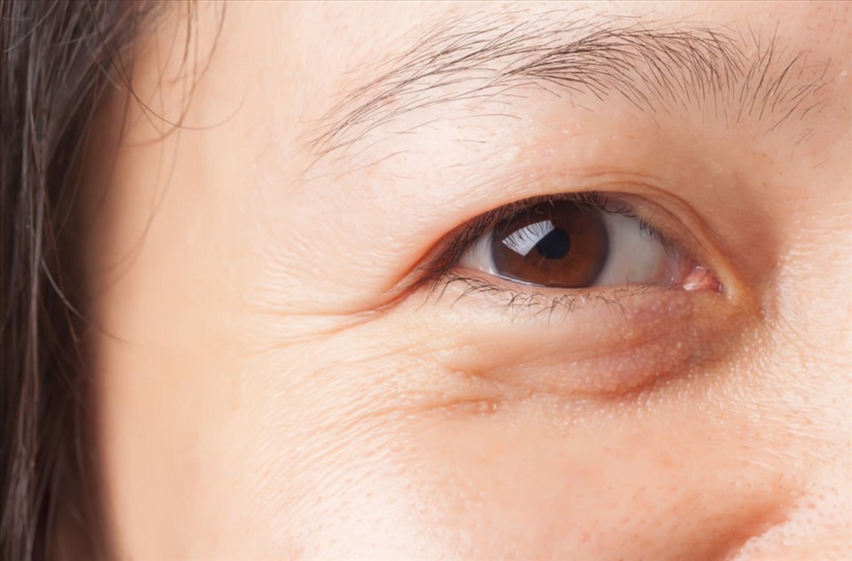 Vùng mắt xuất hiện nếp nhăn, rãnh sâu có thể thực hiện căng chỉ collagen để cải thiện 